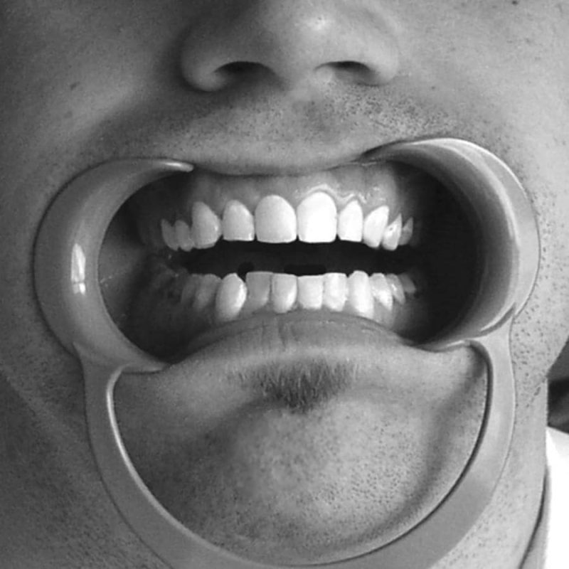 دهان بازکن دندانپزشکی دایرکتا